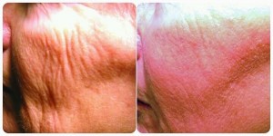 SKIN RESUR 2